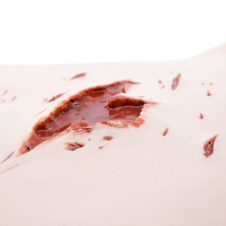 Wunden zum Tragen - schwere Risswunden, oberes Bein