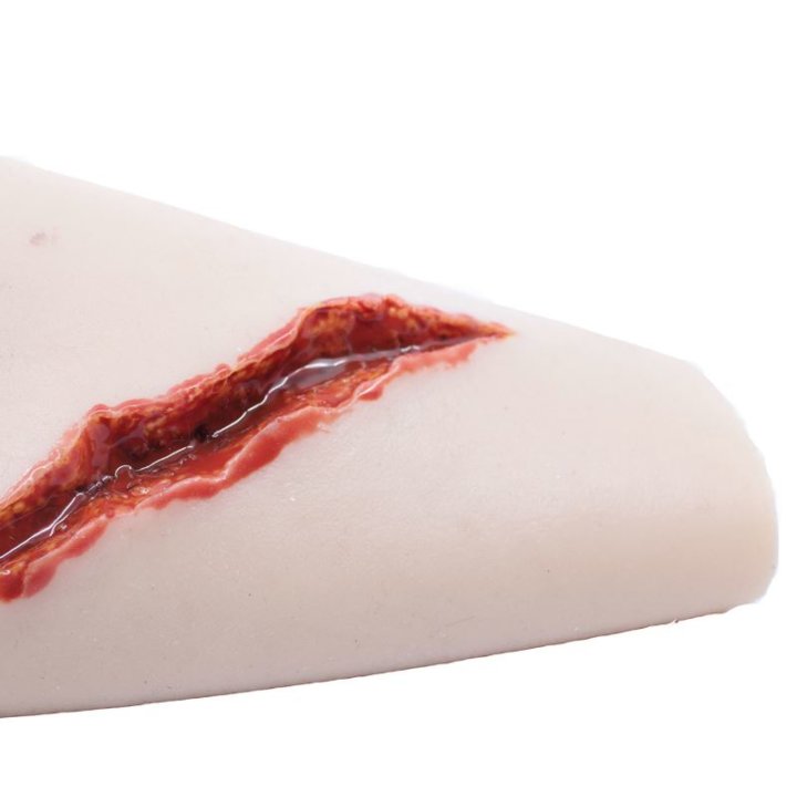 Zu tragende Wunden - unregelmäßige Risswunde am Unterarm mit Ausfluss