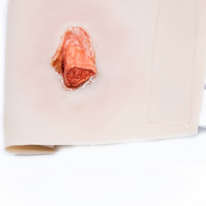 Zu tragende Wunden - offene Fraktur des Oberarms, Oberarm mit Ausfluss