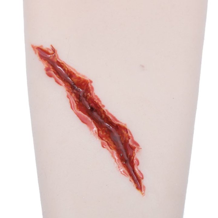 Zu tragende Wunden - unregelmäßige Risswunde am Unterarm mit Ausfluss