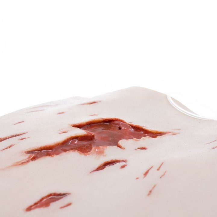 Wunden zum Tragen - schwere Risswunden, oberes Bein mit Ausfluss