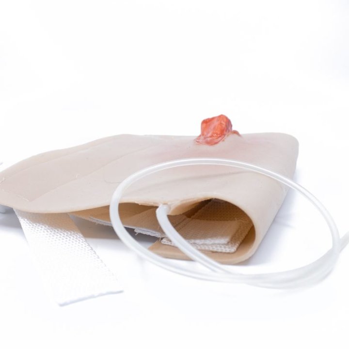 Zu tragende Wunden - offene Fraktur des Oberarms, Oberarm mit Ausfluss