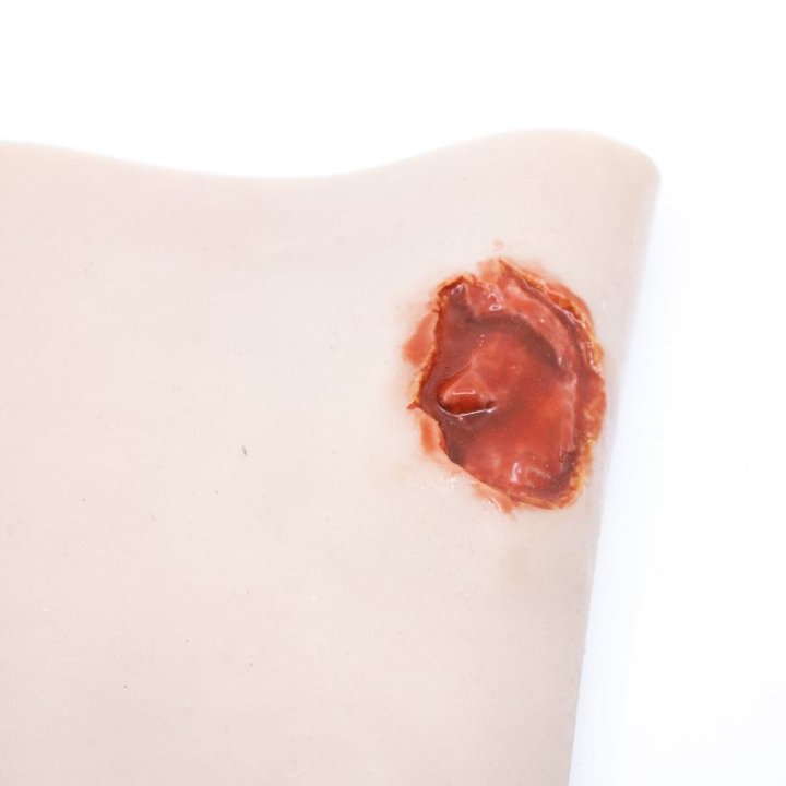 Zu tragende Wunden - Ein-/Ausschusswunde am Unterarm