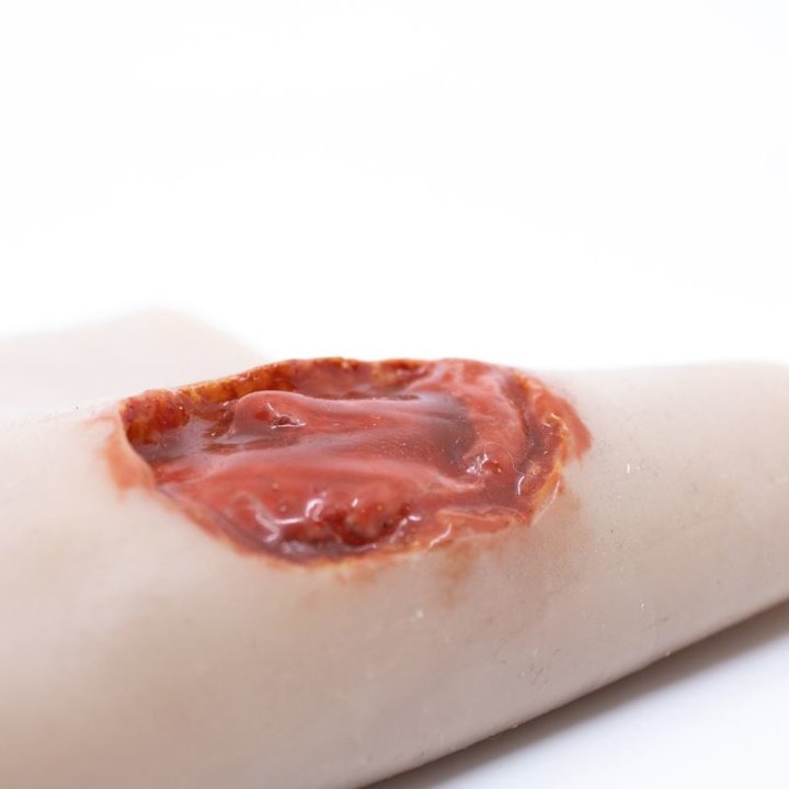 Zu tragende Wunden - Ein-/Ausschusswunde am Unterarm