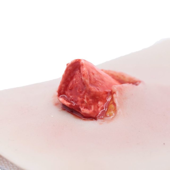 Plaies à porter - fracture ouverte du tibia, jambe inférieure avec écoulement