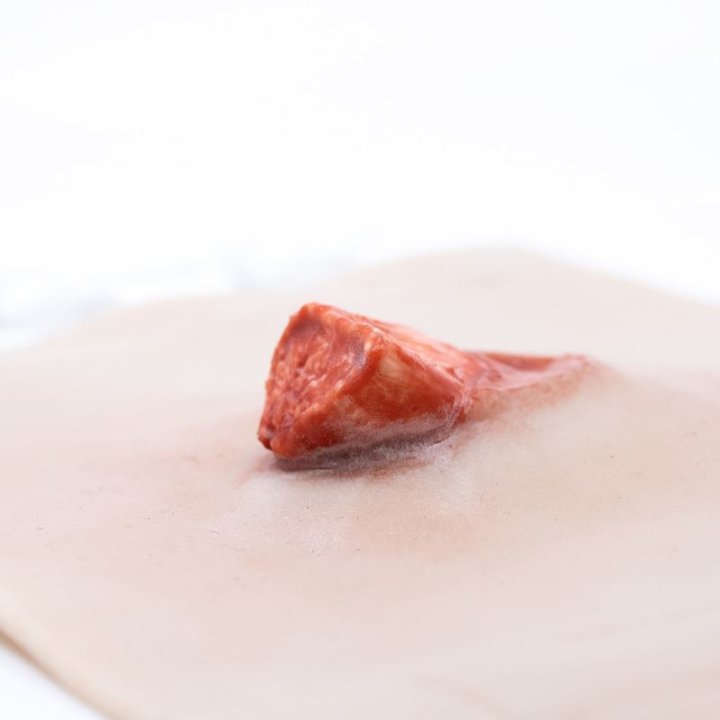 Zu tragende Wunden - offener Bruch des Oberarms, Oberarm