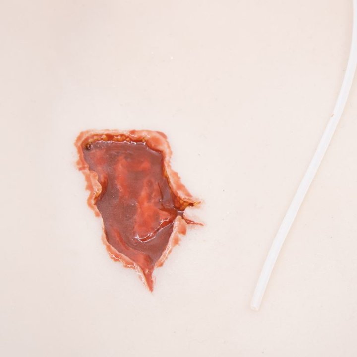 Wunden zum Tragen - Schusswunde Ein-/Austritt, Oberschenkel mit Ausfluss