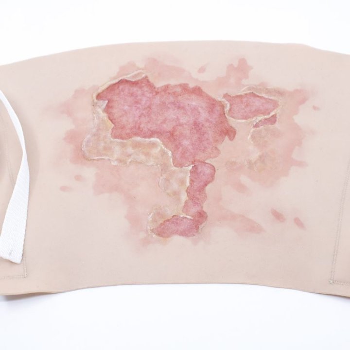 Wunden zu tragen - große Verbrennung Oberschenkel