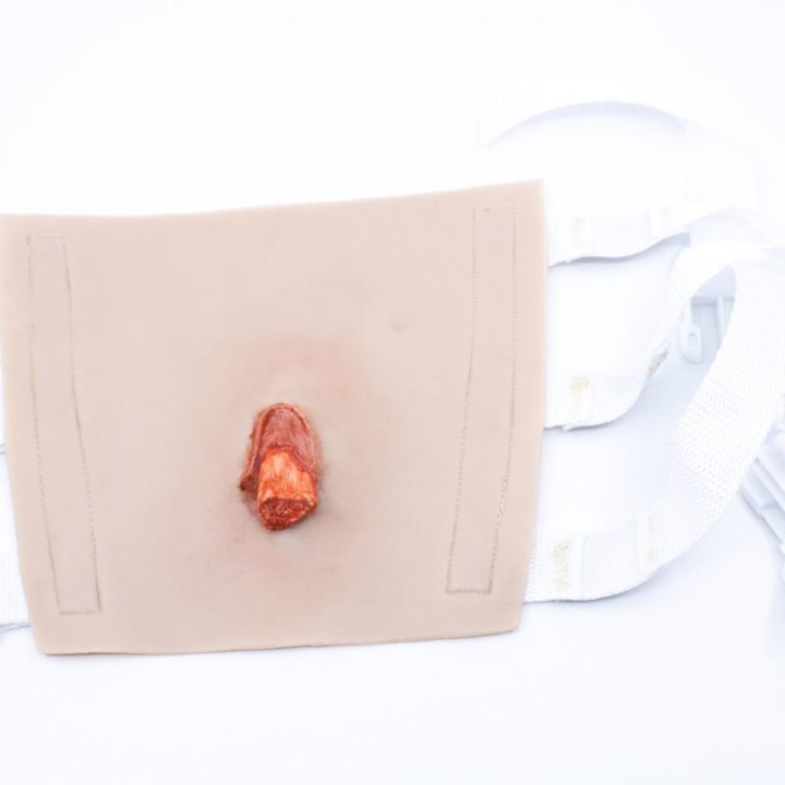 Zu tragende Wunden - offener Bruch des Oberarms, Oberarm