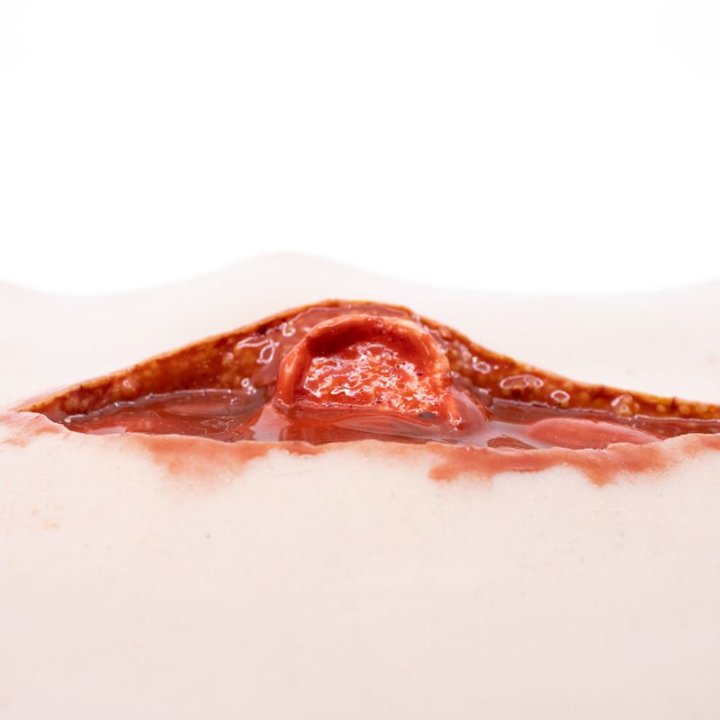 Zu tragende Wunden - offener Oberschenkelbruch, oberes Bein