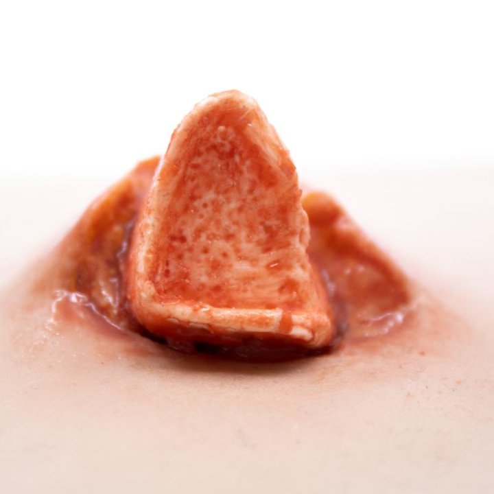 Zu tragende Wunden - offener Schienbeinbruch, Unterschenkel