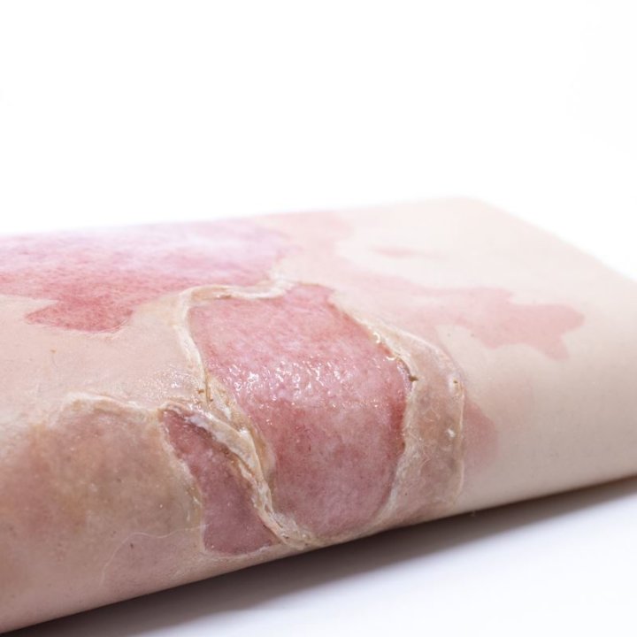 Wunden zu tragen - große Verbrennung Oberschenkel