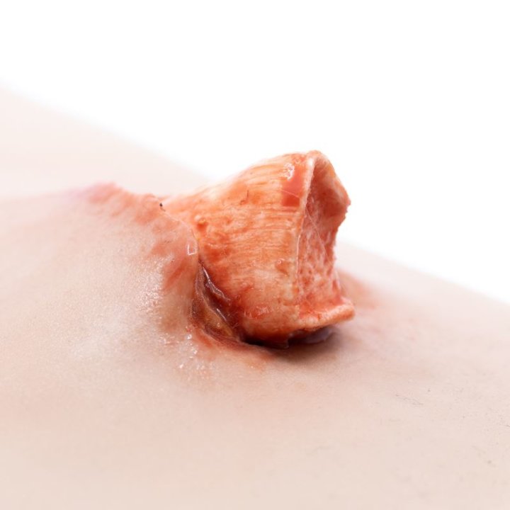 Zu tragende Wunden - offener Schienbeinbruch, Unterschenkel