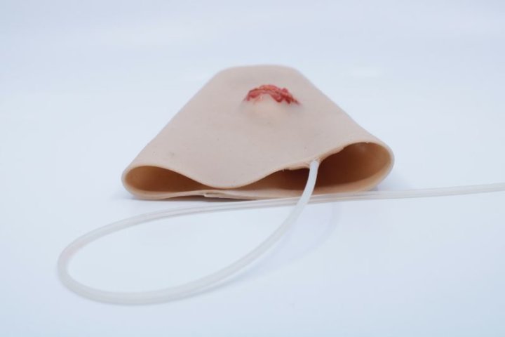 Zu tragende Wunden - offener Bruch am Unterarm mit Ausfluss