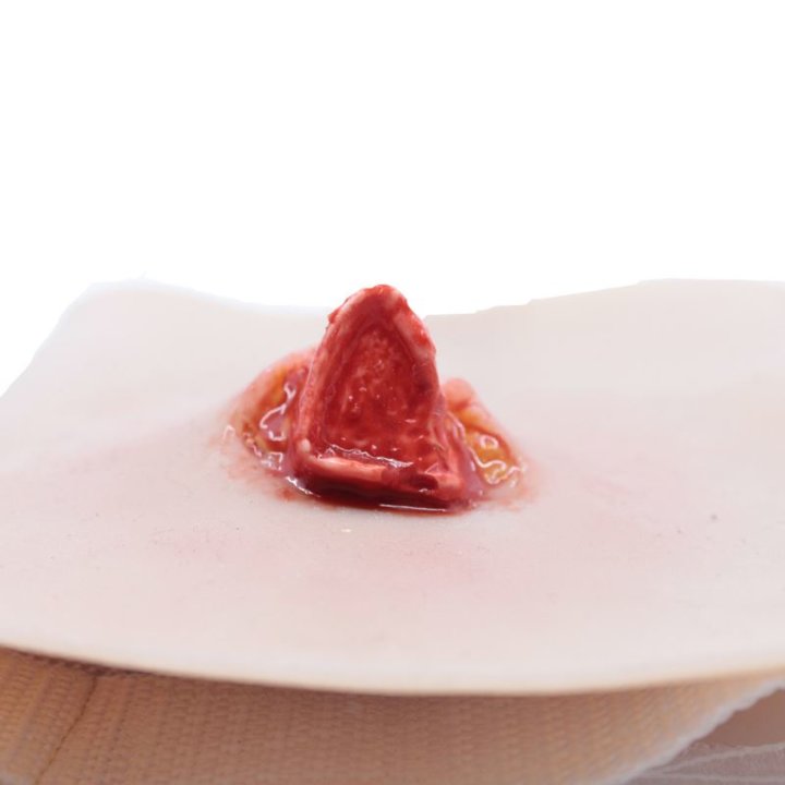 Plaies à porter - fracture ouverte du tibia, jambe inférieure avec écoulement