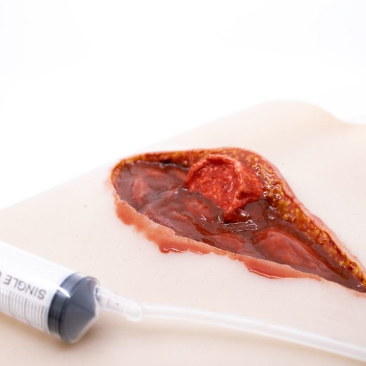 Zu tragende Wunden - offener Oberschenkelbruch, oberes Bein mit Ausfluss