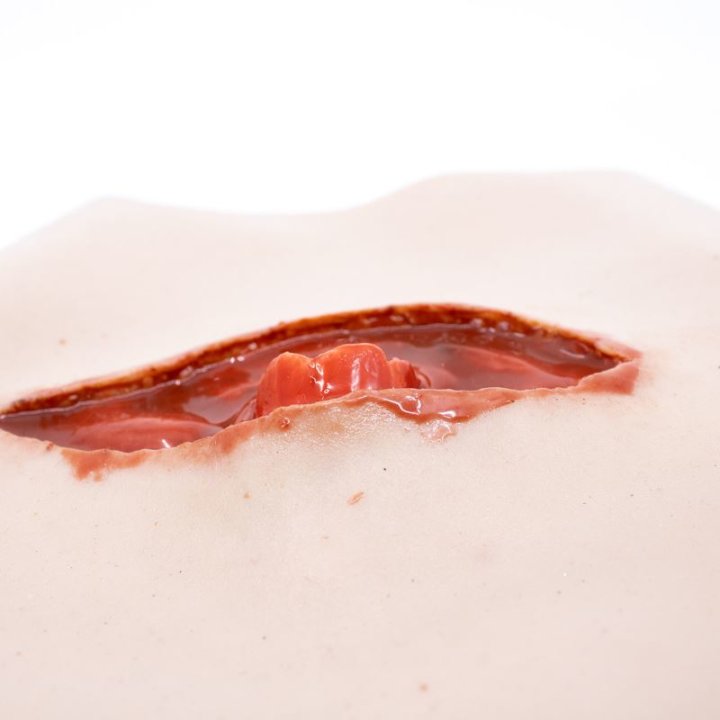 Zu tragende Wunden - offener Oberschenkelbruch, oberes Bein