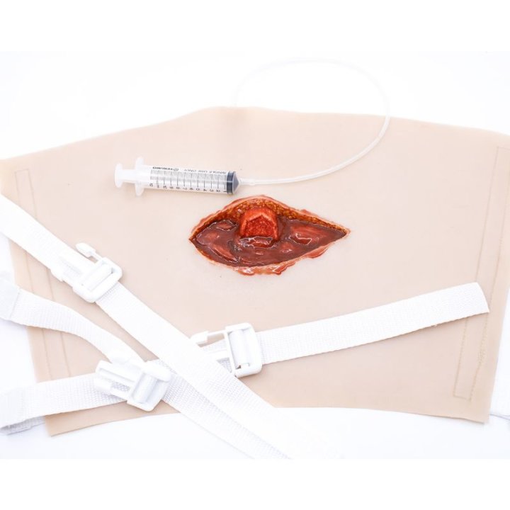 Zu tragende Wunden - offener Oberschenkelbruch, oberes Bein mit Ausfluss