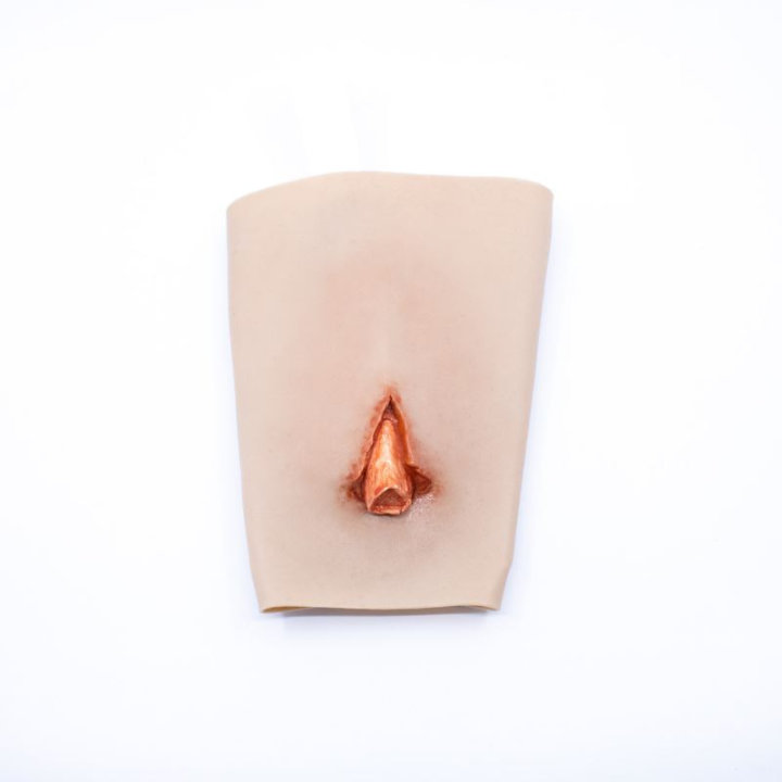 Plaies à porter - fracture ouverte du tibia, jambe inférieure